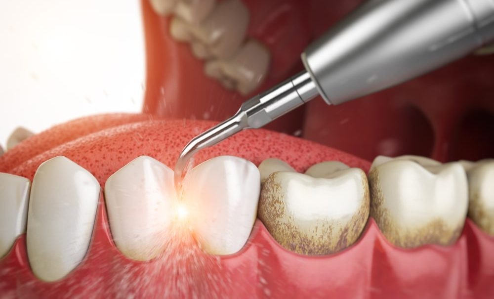 professionalnaya-chistka-zubov